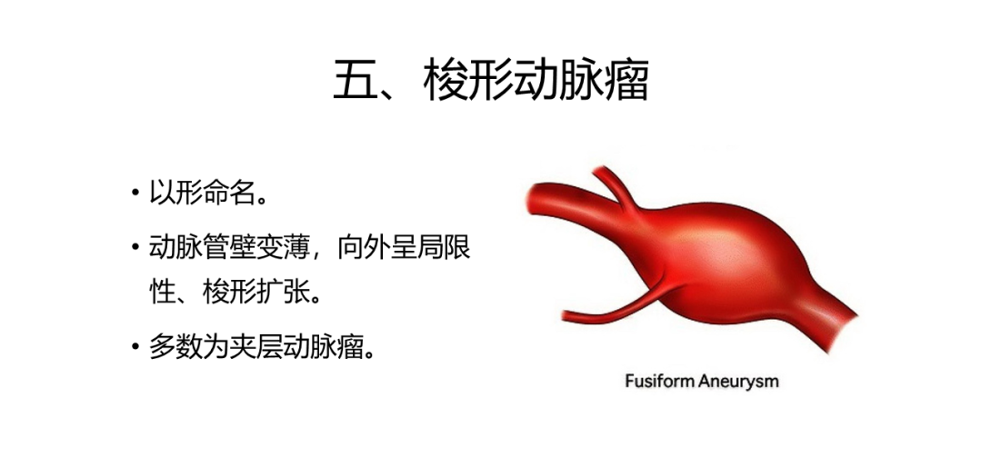 颅内动脉瘤的类型知多少?