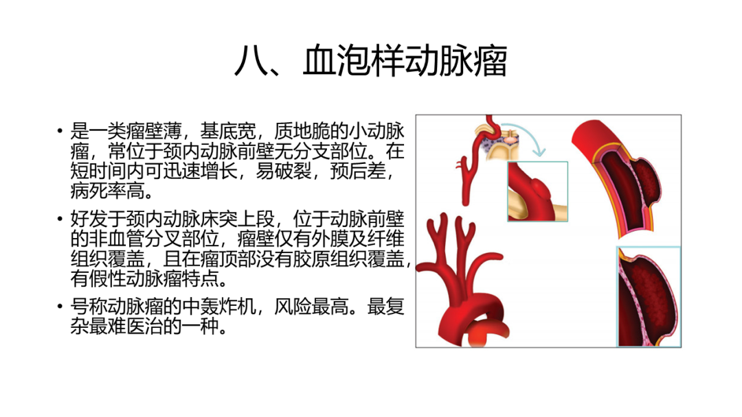 颅内动脉瘤的类型知多少