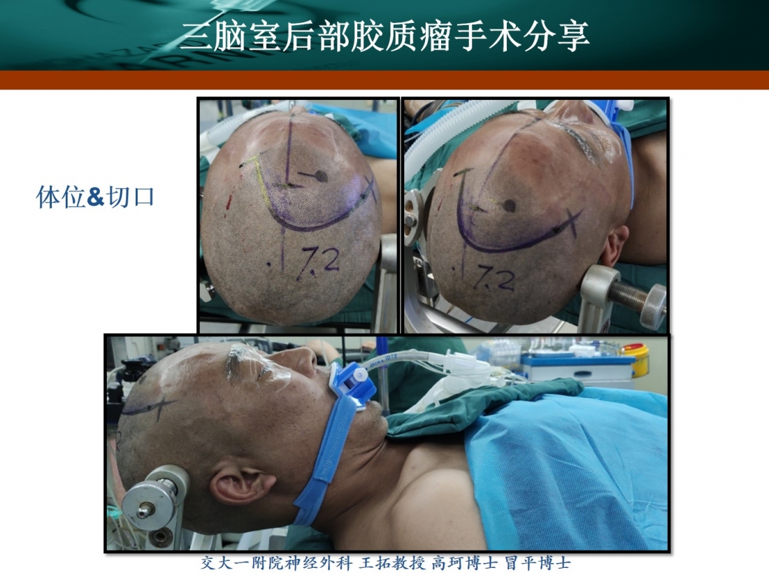 王拓教授团队三脑室后部胶质瘤手术分享