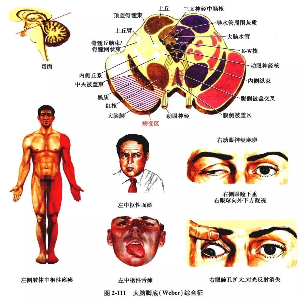 中脑红核综合征(动眼神经交叉性黑质综合征,benedikt 综合征:本征又