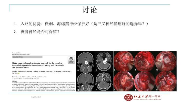 内镜经蝶窦翼突入路切除meckel腔三叉神经鞘瘤