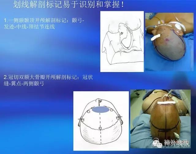 标准大骨瓣切口图片