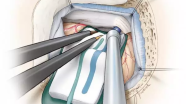 乙状窦后入路| The Neurosurgical Atlas系列