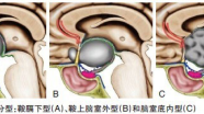 根据颅咽管瘤解剖分型选择手术入路
