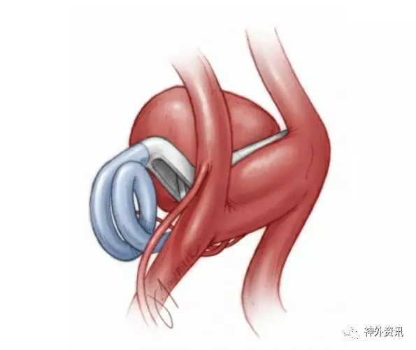 前交通动脉瘤手术要点| The Neurosurgical Atlas全文翻译