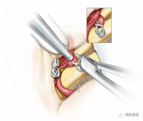 前交通动脉瘤手术要点| The Neurosurgical Atlas全文翻译