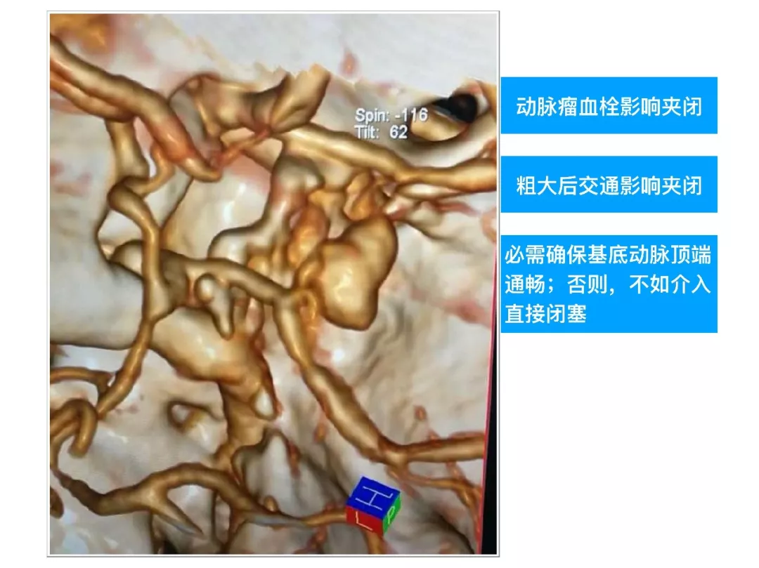 壹生资讯-中国首例自膨式动脉瘤内栓塞系统植入手术在宣武医院完成