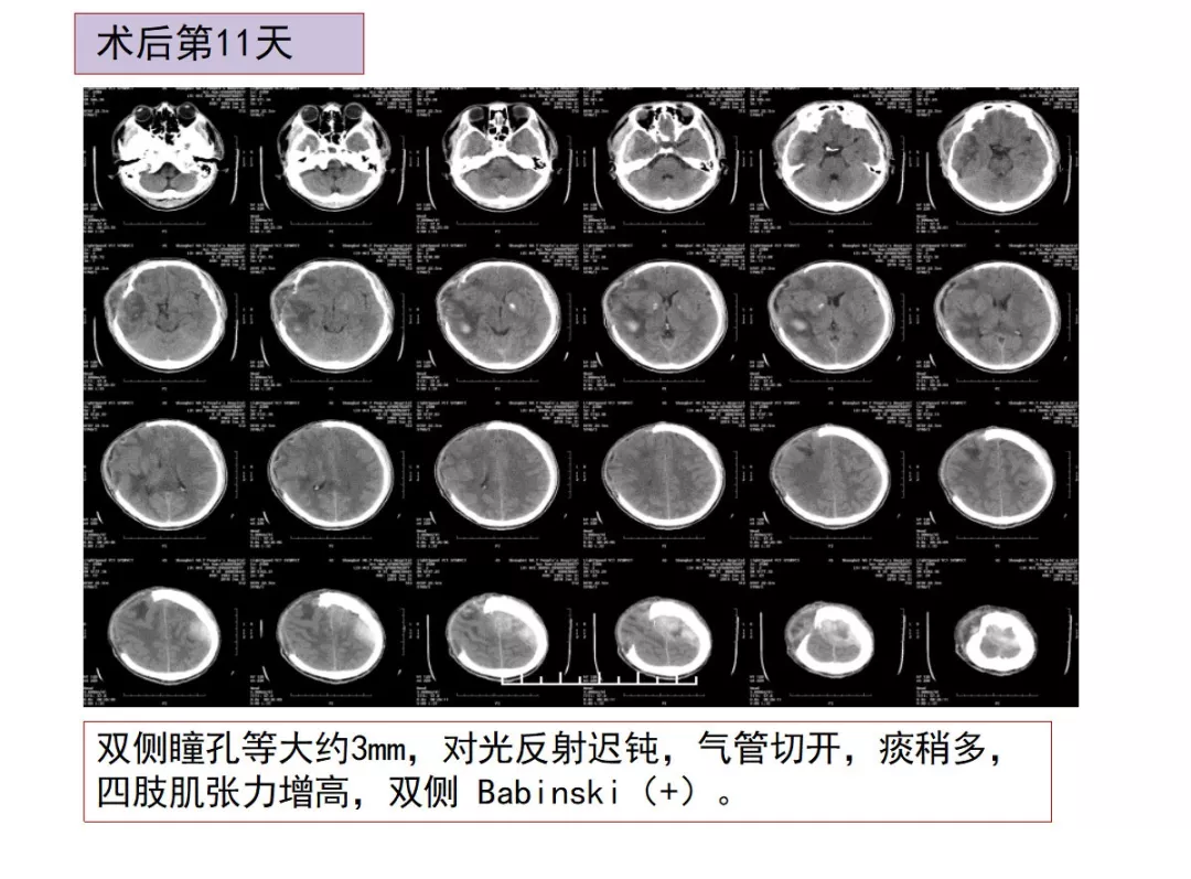 成功救治重型颅脑损伤患者一例丨颅脑创伤-神经重症病例周刊(第58期) - 脑医汇