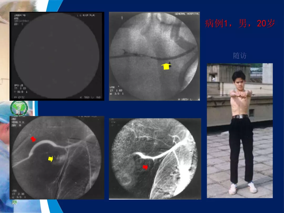 39年前开创“复合手术” ，治愈颅底高位颈内动静脉瘘随访报告 脑医汇 神外资讯 神介资讯 2793