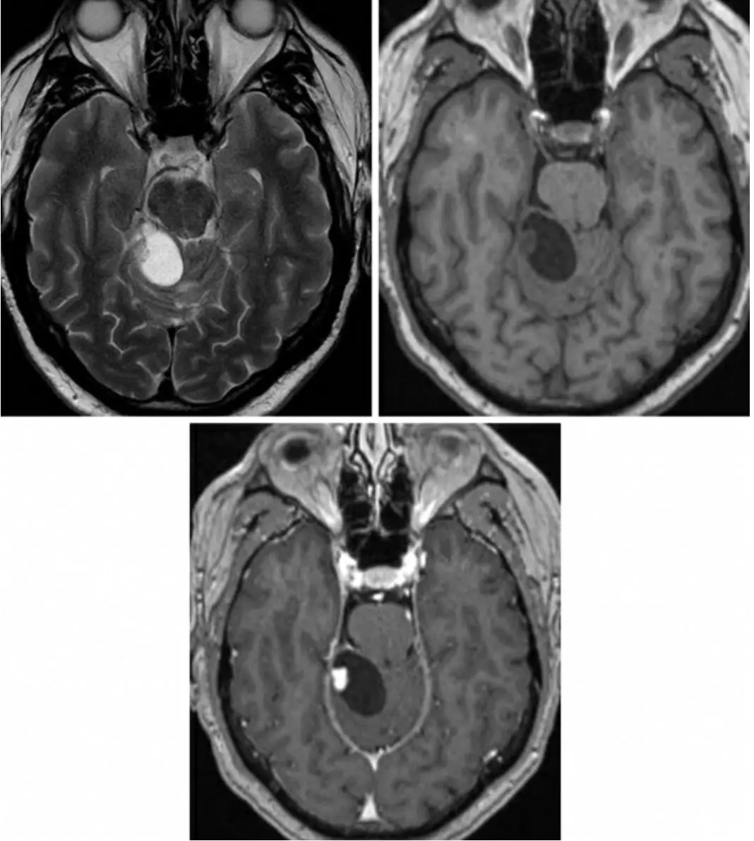 高尚病例：少见的原发性骨淋巴瘤 PET/CT 显像一例-医院汇-丁香园