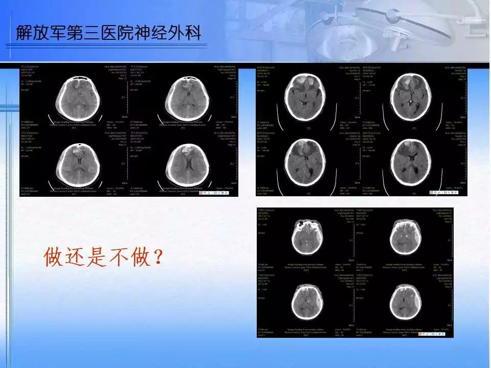 双额叶脑挫裂伤诊治中的一点思考丨 颅脑创伤-神经重症病例周刊（94期） - 脑医汇