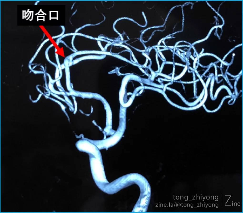 腦血管重建術系列手工製作前交通動脈a3a3側側吻合術