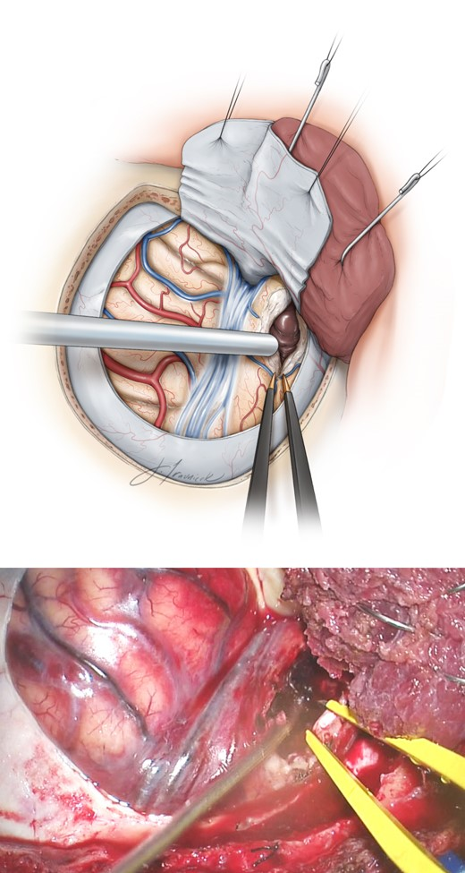 合併血腫的大腦中動脈動脈瘤手術策略與技巧theneurosurgicalatlas