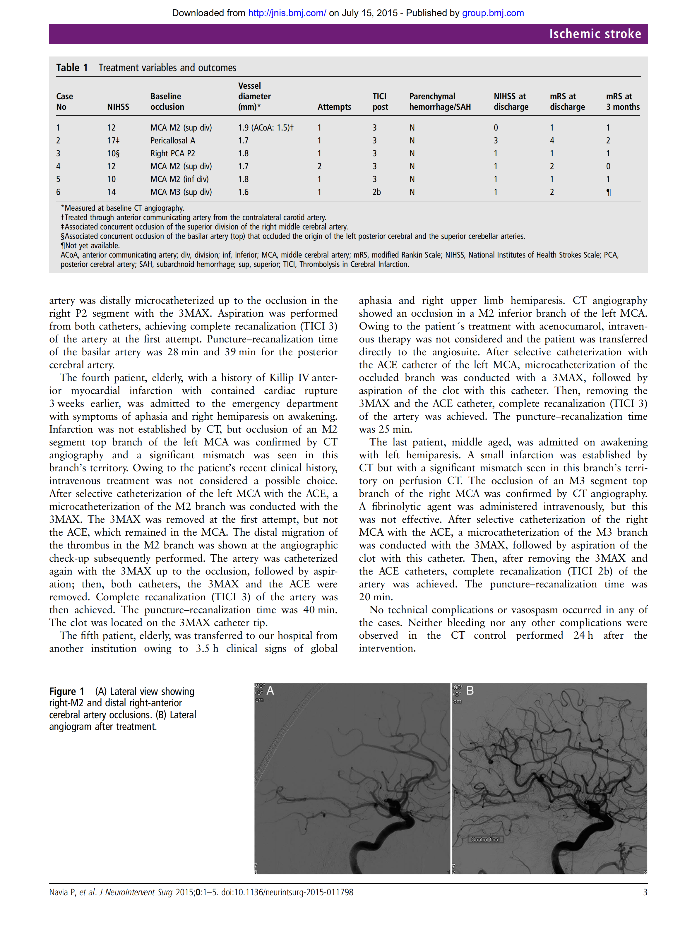 3MAX Distal Occlusion Spanish experience JNIS 2015 脑医汇 神外资讯 神介资讯
