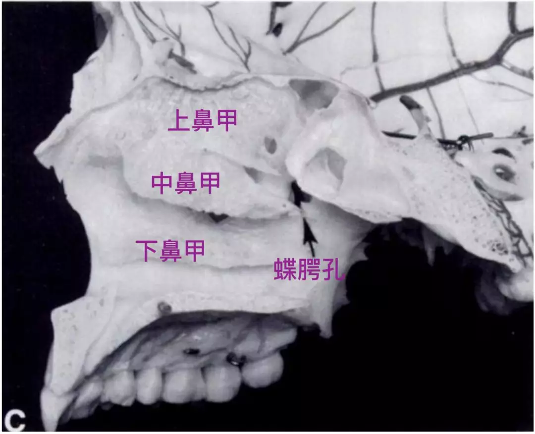 上颌骨及其相关联骨骨折-临床应用解剖学-医学