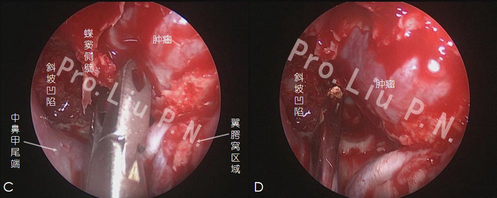 b:經左側中鼻道逐步切除鉤突,篩泡,篩漏斗及後篩,開放左側蝶竇前壁