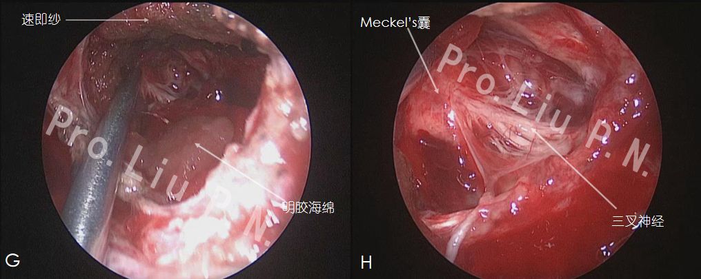 经右侧中鼻道序贯切除中鼻甲,钩突,筛泡及筛漏斗后,开放翼腭窝前壁