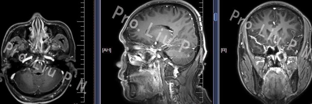 術後mri七,手術案例4-經篩-翼突入路切除翼顎窩神經鞘瘤術前mri翼顎窩