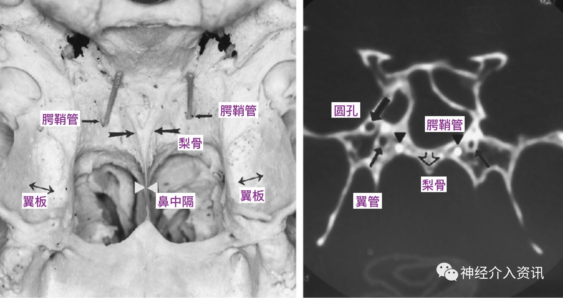 成人腭大孔解剖与腭穹隆形态相关性的CBCT影像研究