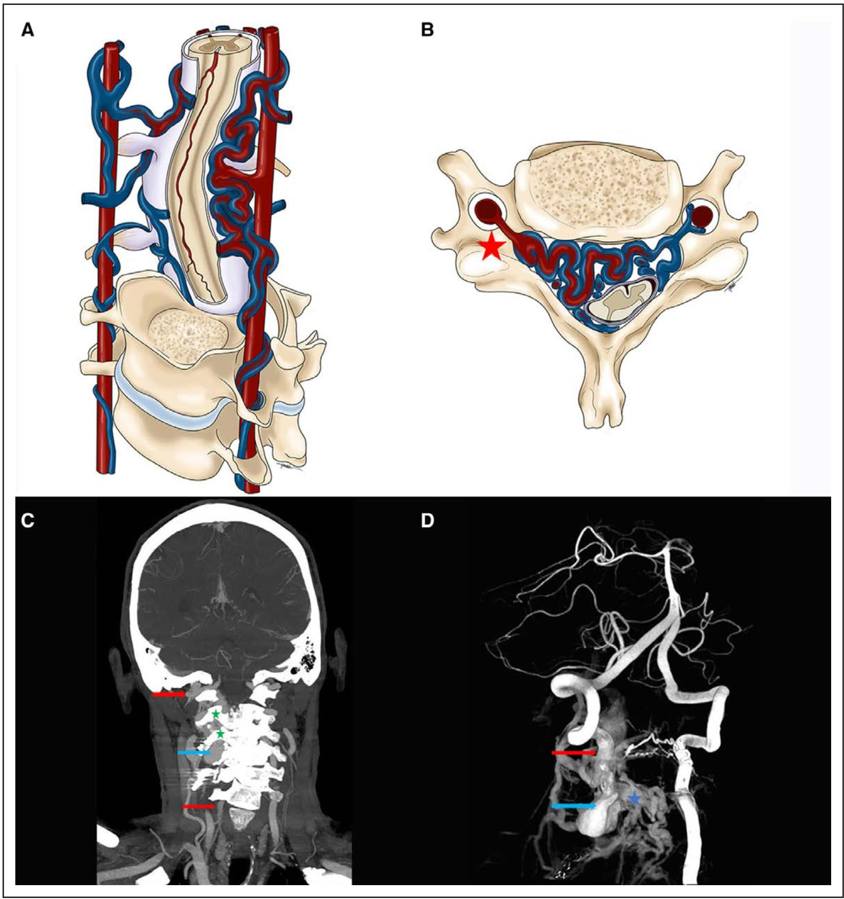 a,b:颈椎旁动静脉瘘的三维(a)和轴位(b)解剖示意图,显示椎动脉和椎旁
