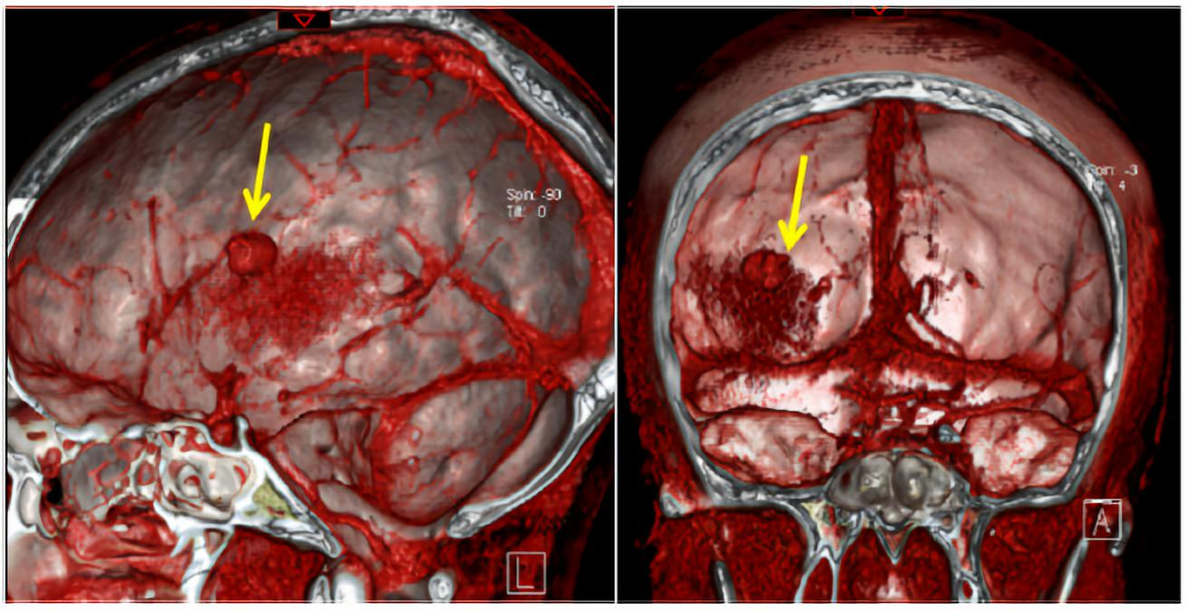 1例大脑中动脉自发性假性动脉瘤破裂的病案报道