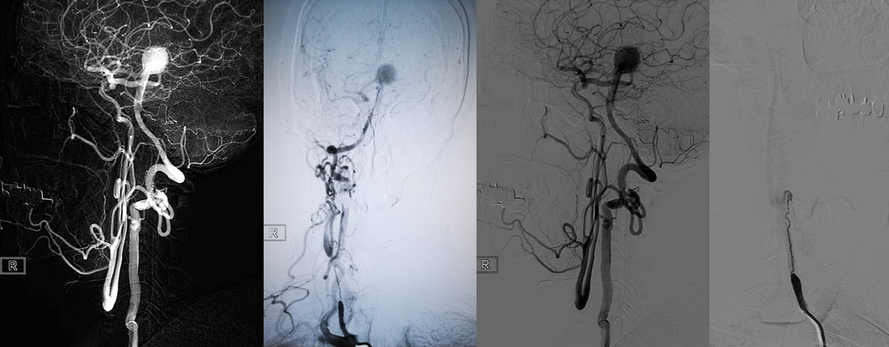 馮雷教授基底動脈尖大動脈瘤y型支架栓塞右側頸總動脈閉塞再通術