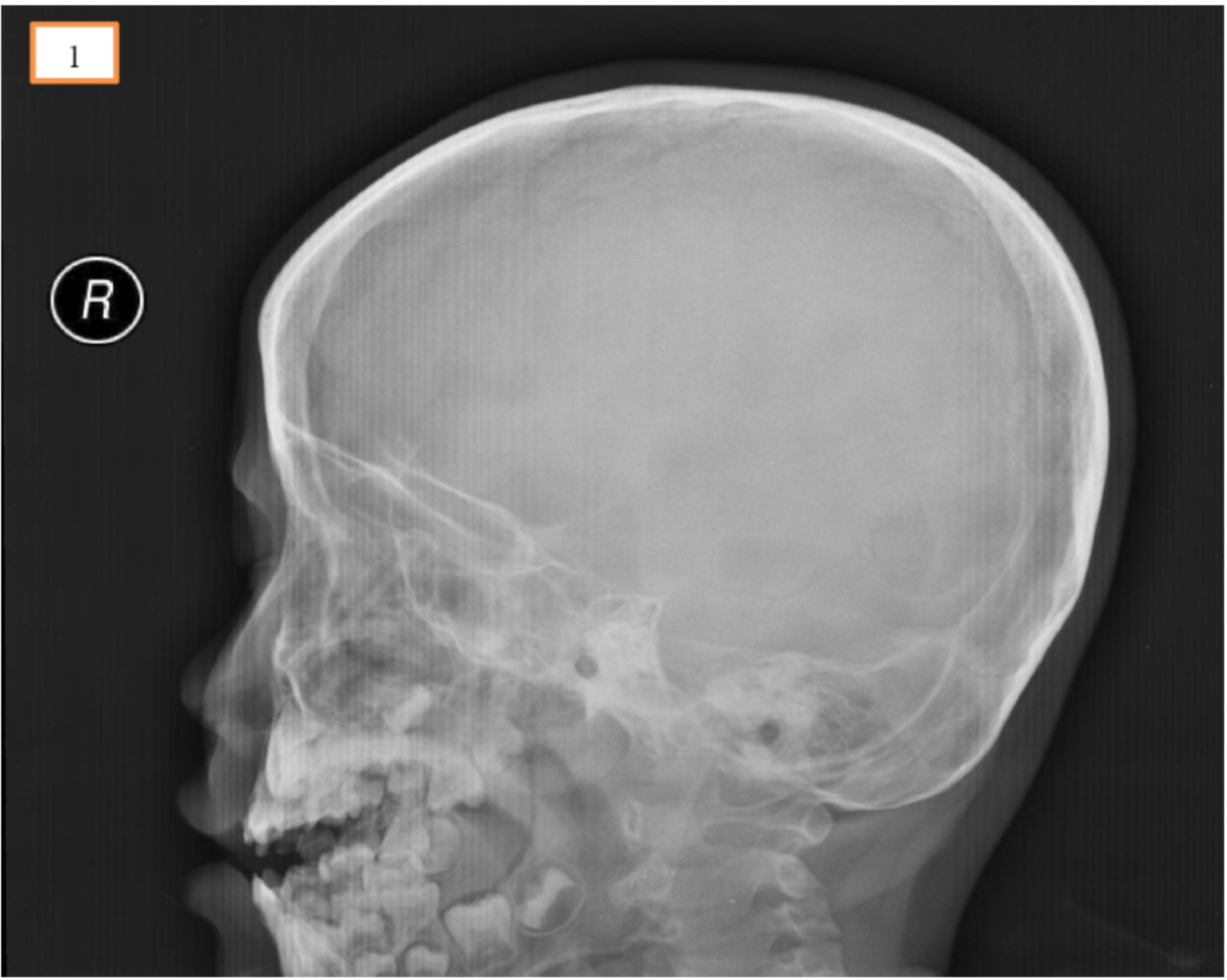 颅脑外伤后脑脊液鼻漏4年多时间内：3次脑脊液漏修补术和1次开颅术后颅内感染加重 - 知乎