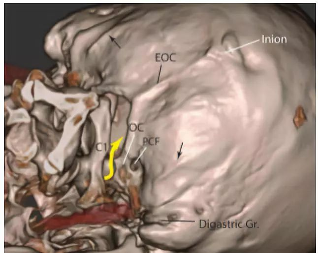 eoc:枕外嵴;gr.:溝;inion:枕骨隆突.