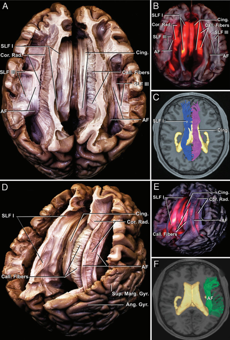 神外专题二大脑白质纤维束的解剖意义