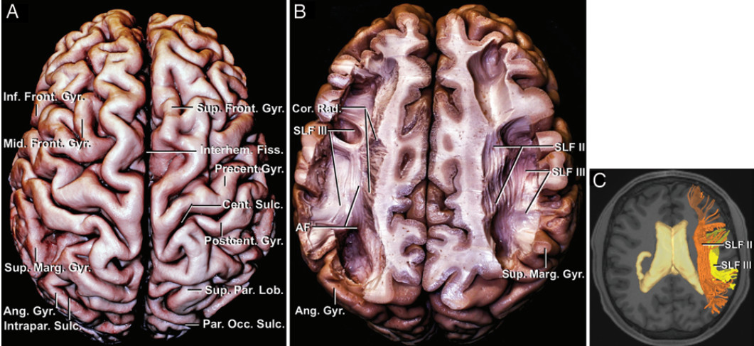 显示白质纤维束与侧脑室的关系;c:mr纤维束成像显示af(绿色)和vof
