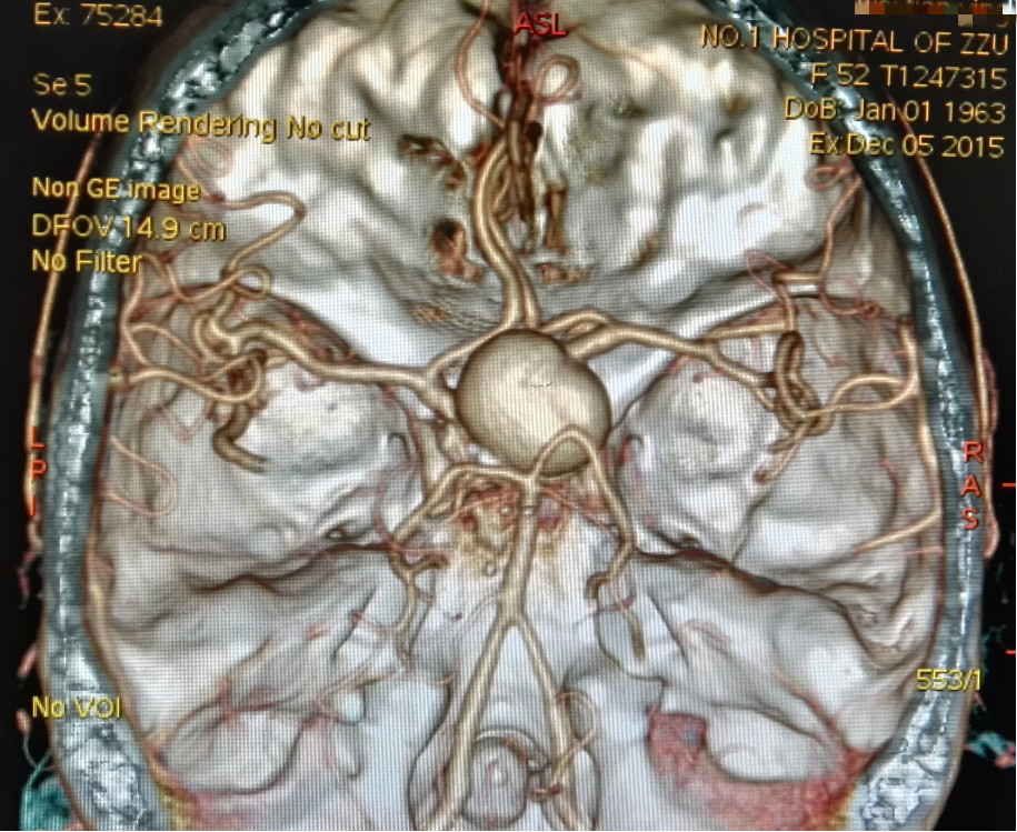 脑血管mra解剖图图片