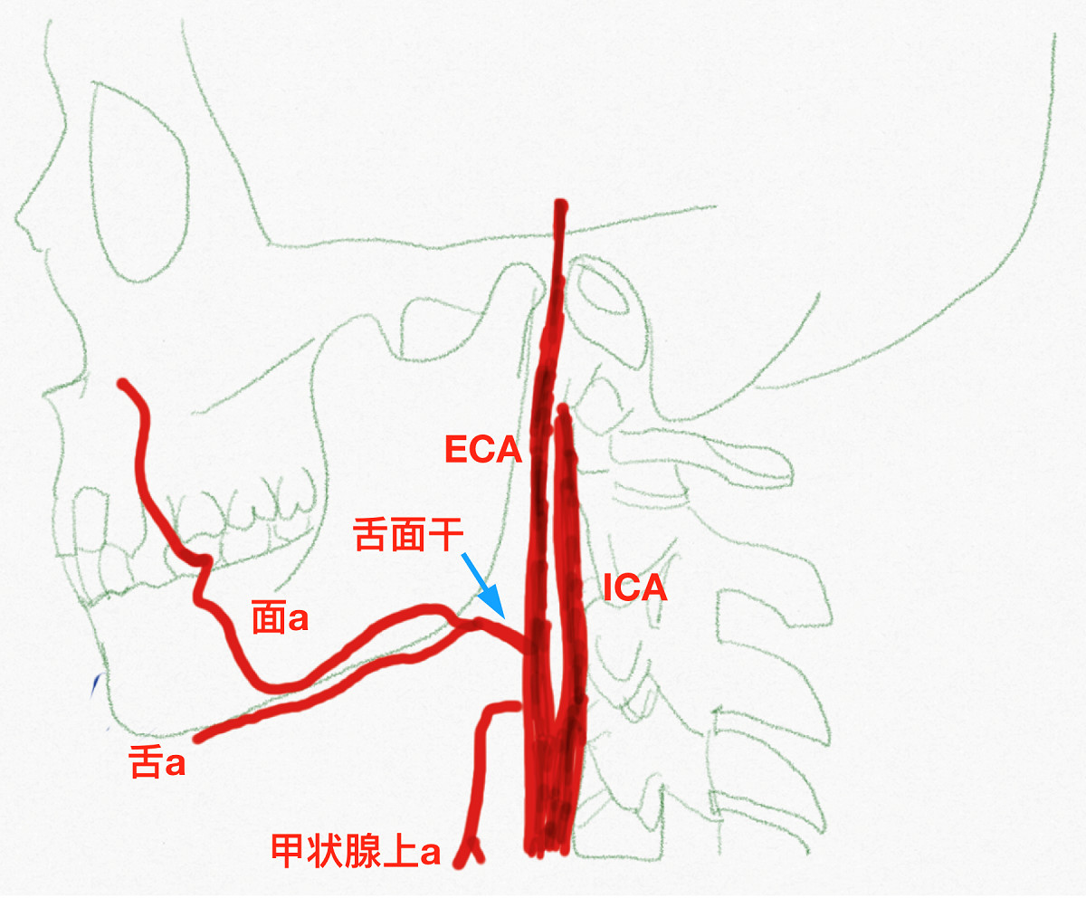 舌动脉和面动脉共干,称为舌面干(linguofacial trunk,是比较常见的