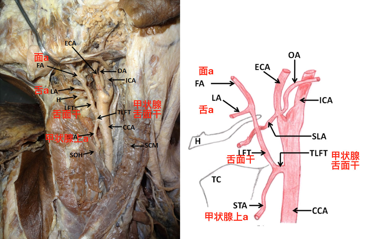 脑血管解剖学习笔记第21期:面动脉起源的变异 