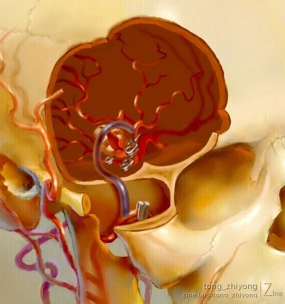 动脉桡动脉大脑中动脉搭桥治疗右侧m2上干破裂解离性血栓性巨大动脉瘤