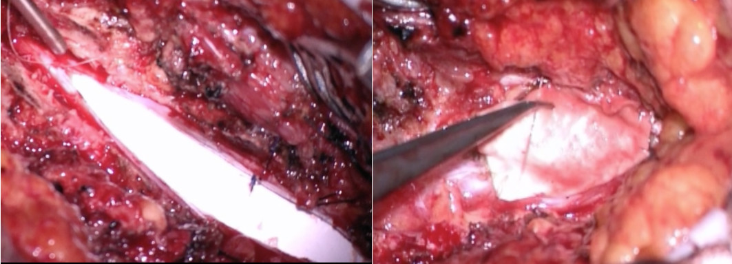 李振教授腰骶部椎管內脂肪瘤大部分切除術脊髓栓系鬆解術