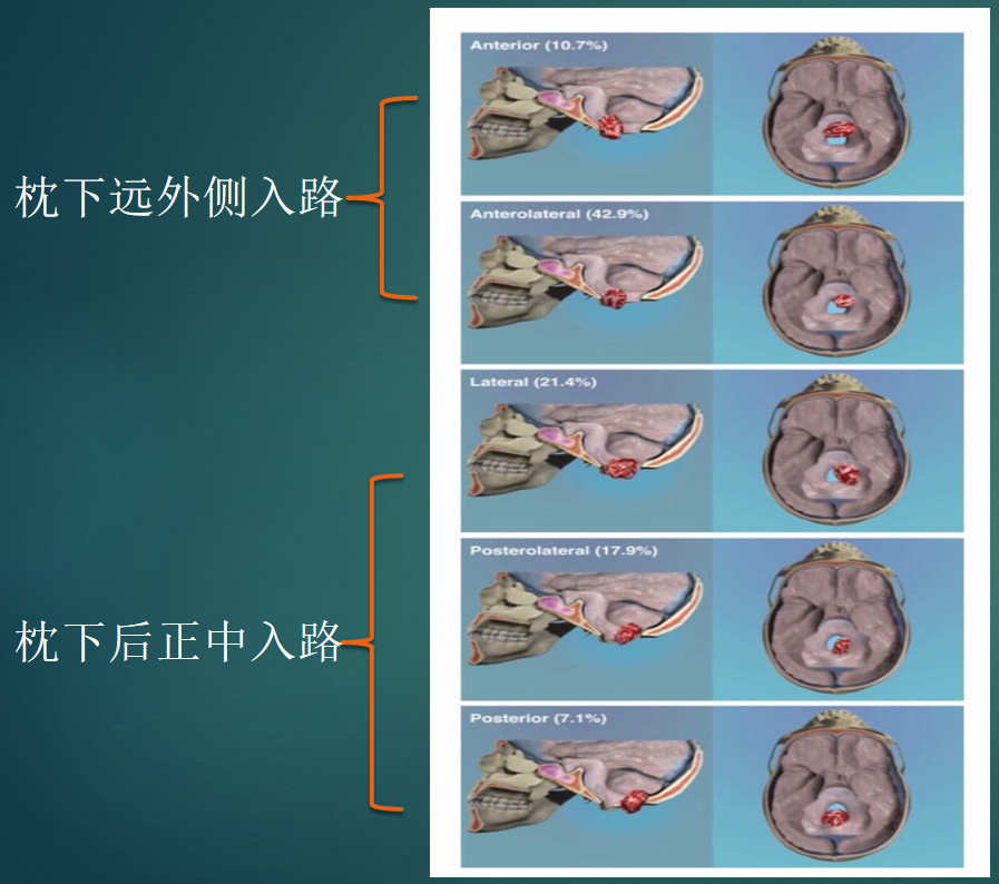 赵宁辉主任包绕椎动脉入颅处脑膜瘤切除术