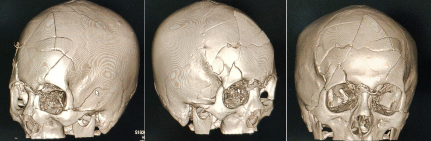 重型闭合性颅脑损伤复杂性颅骨骨折一例颅脑创伤神经重症病例周刊150