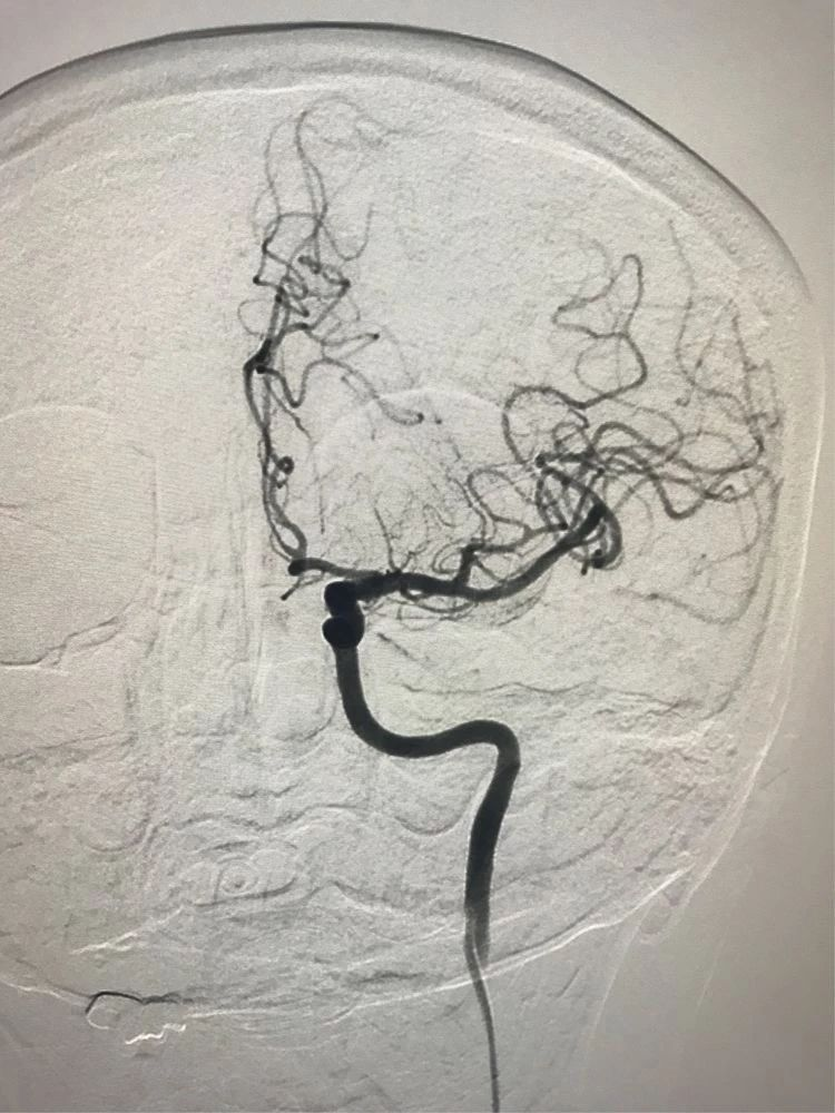 双侧胚胎型大脑后动脉图片