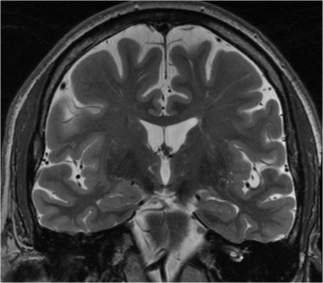 杏仁体MRI图片