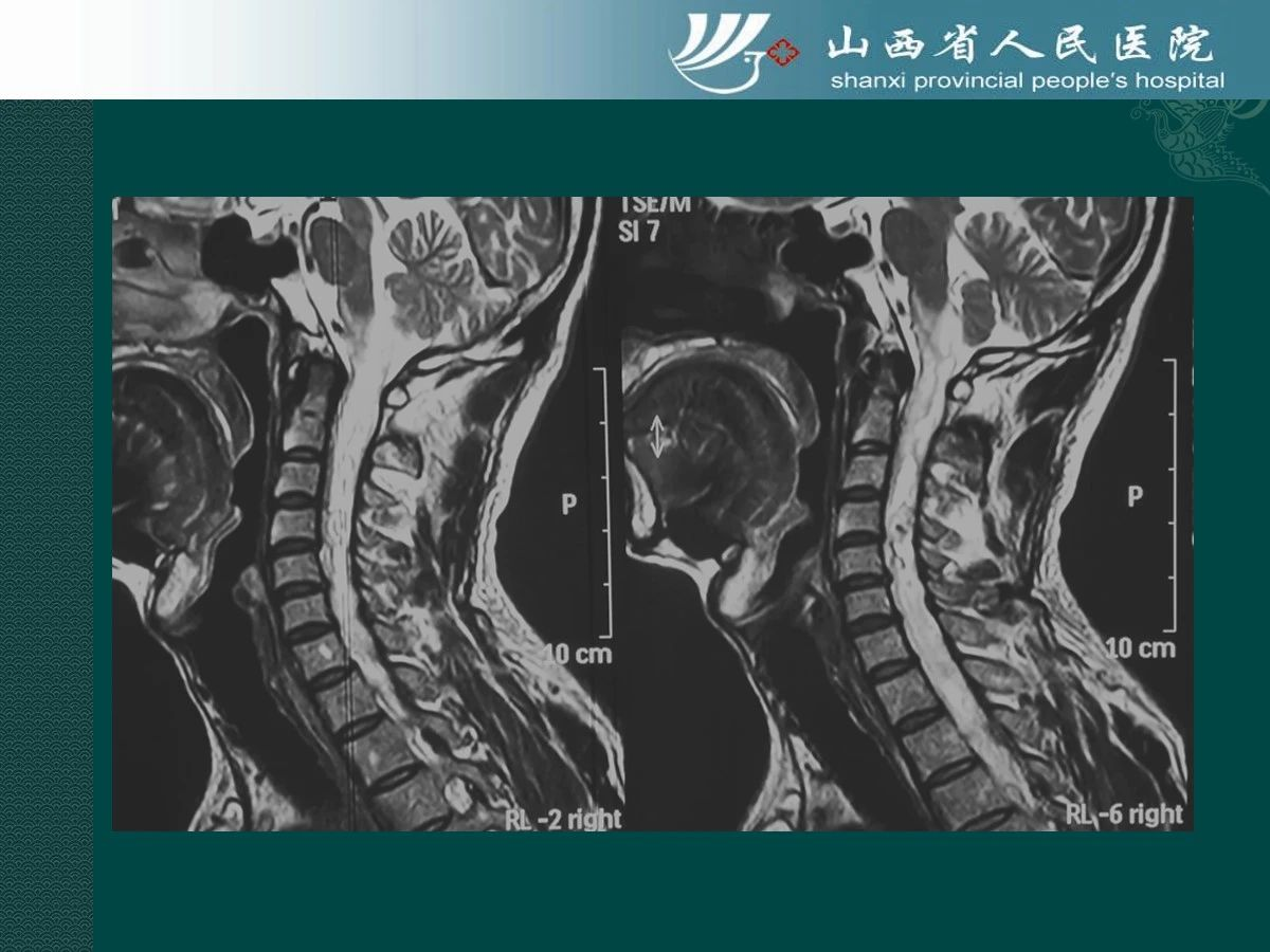 贾贵军副教授团队颈髓血管母细胞瘤诊断及治疗