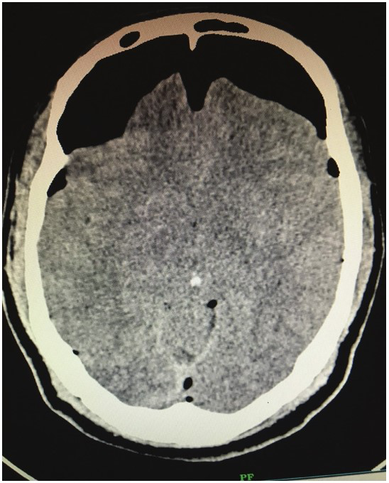 1例迟发性外伤后张力性气颅病例报告