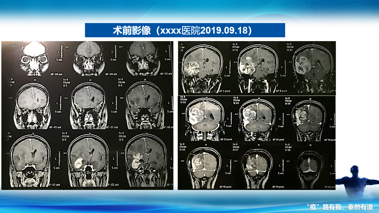 女性,47歲,因膠質母細胞瘤就診,行