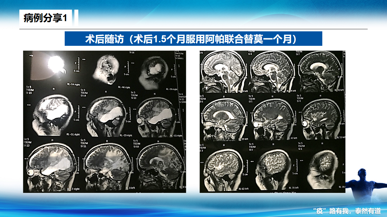 一個右顳枕部膠質母細胞瘤whoiv級復發的病例答疑