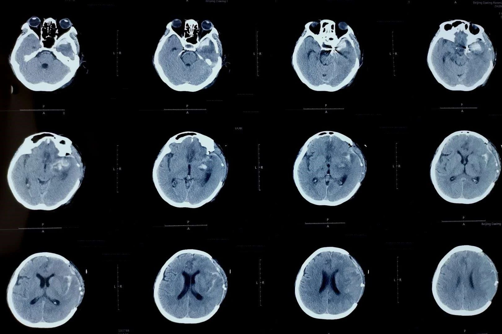 術後第4天覆查頭顱ct示硬膜下血腫完全清除,動脈瘤栓塞術後狀態(圖10)