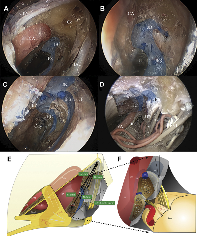 在內鏡和神經導航輔助下擴大經巖骨菱形區入路和經v2v3神經間隙處理