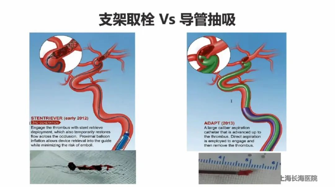 美力有约鸿儒思辨取栓鸿儒云端思辨初学须始于支架取栓