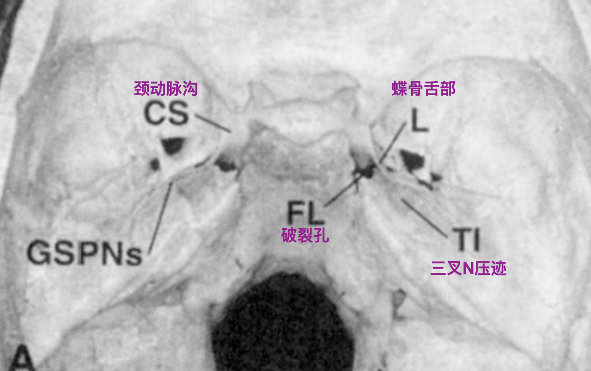 颅底破裂孔图片