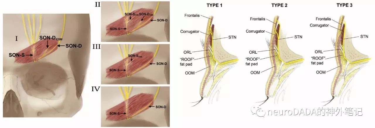 圖17:皺眉肌對眶上神經(左)和滑車上三角(右)的卡壓類型第四個部位
