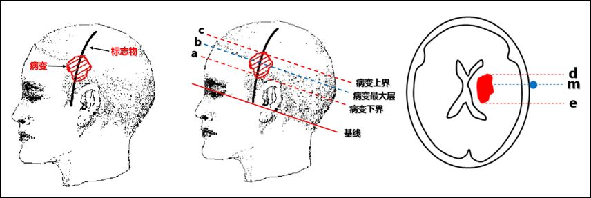 颅骨体表定位标志图片