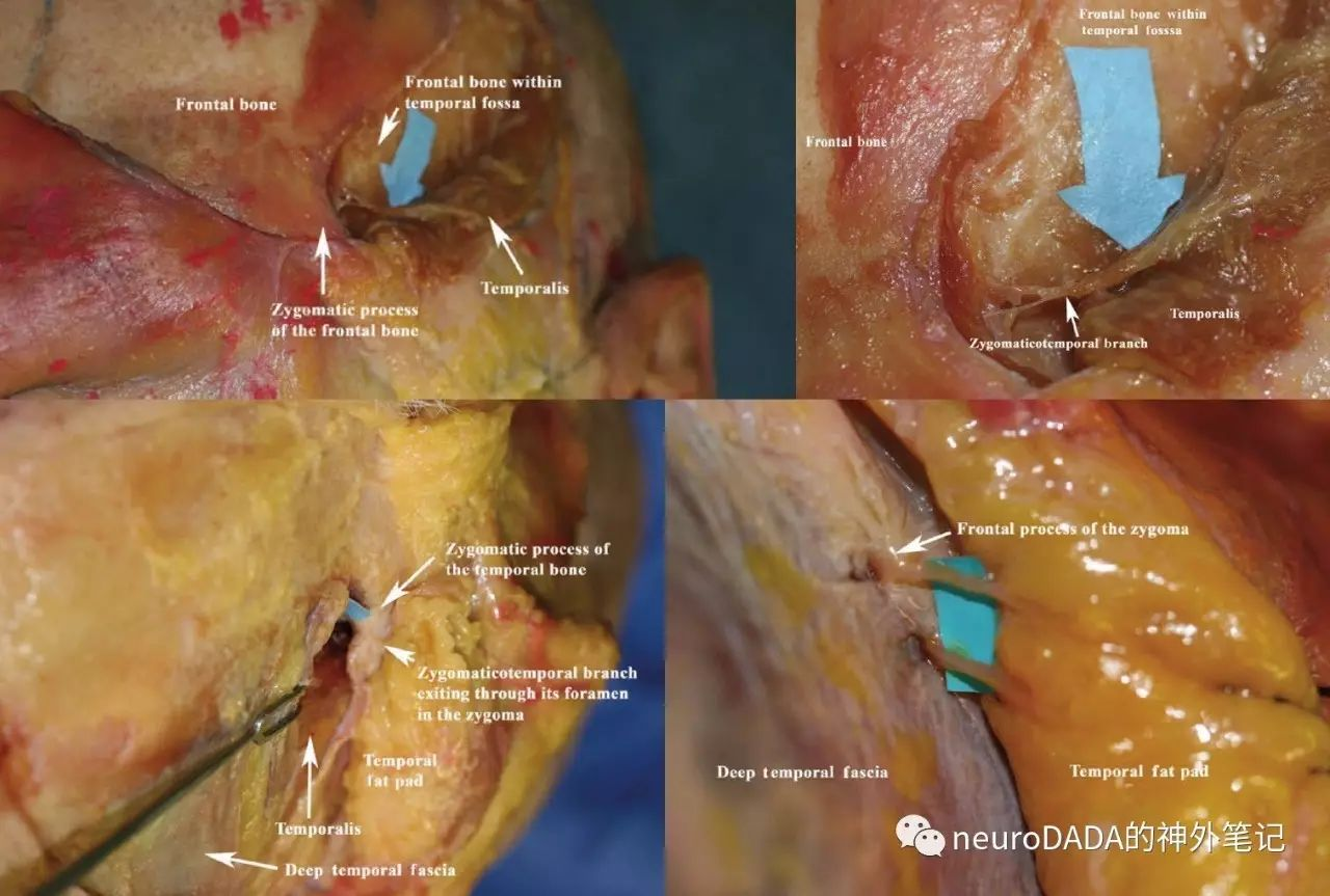 解剖小细节颧颞静脉和神经